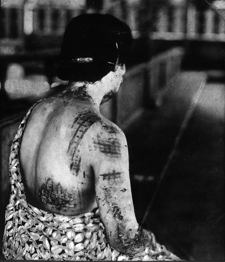 A burned body in the ruins 500 meters from the hypocenter; and the pattern of a woman’s kimono burned into her skin. The intense heat rays of the Hiroshima bomb reached several million degrees Celsius at the hypocenter and incinerated everything within approximately two kilometers. The heat scorched flesh and ignited trees and other flammable materials as far as 3.5 kilometers from ground zero. Flash burns from the primary heatwave caused most of the deaths at Hiroshima. By the end of 1945, an estimated 140,000 were killed by the blast, heat, and radiation effects of the nuclear attack. (Photo: Hiroshima Peace Memorial Museum) 